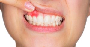 Gum disease prevention in Egham at Crown House Dental Practice